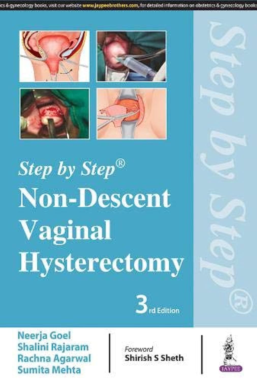 Step by Step Non-Descent Vaginal Hysterectomy